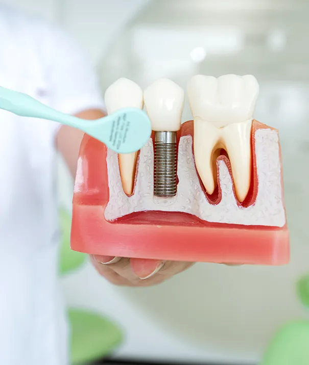 What Are Dental Implants1