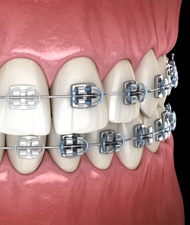What is Traditional Orthodontics