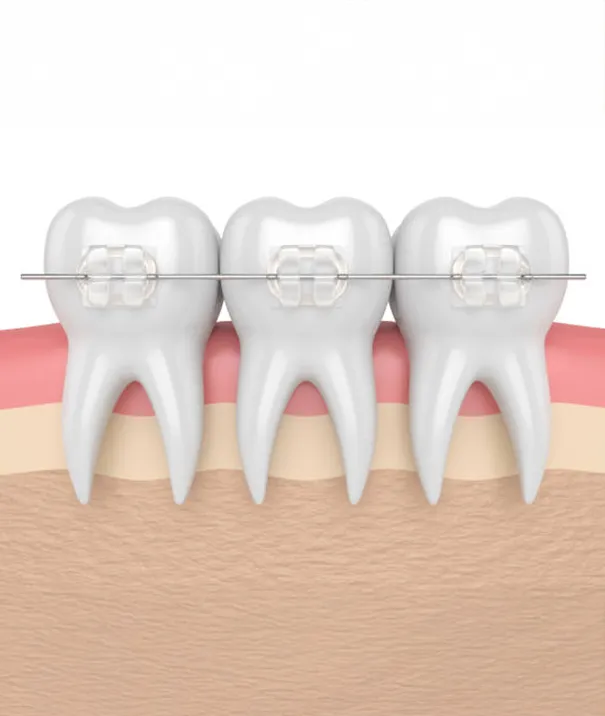 What to Expect During Traditional Orthodontics Treatment Process