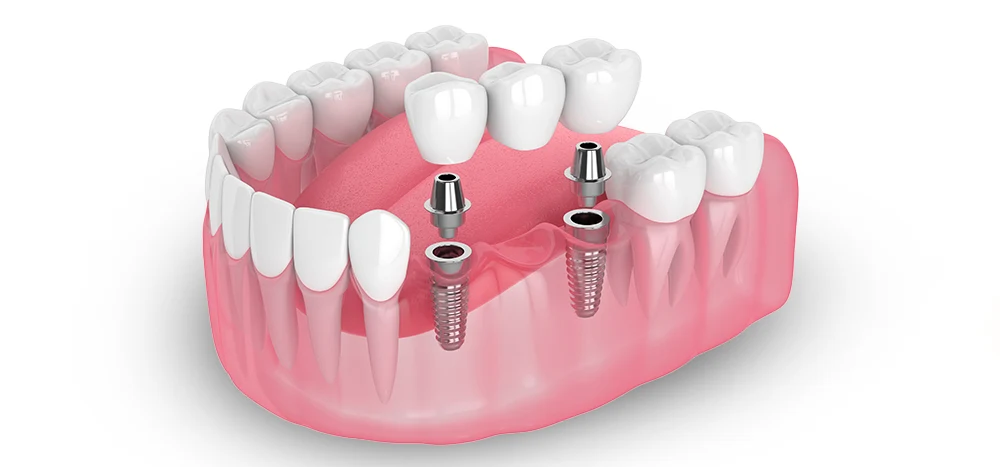 How Much Does a Dental Bridge Cost