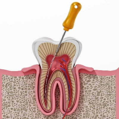 Are Root Canals Bad for You